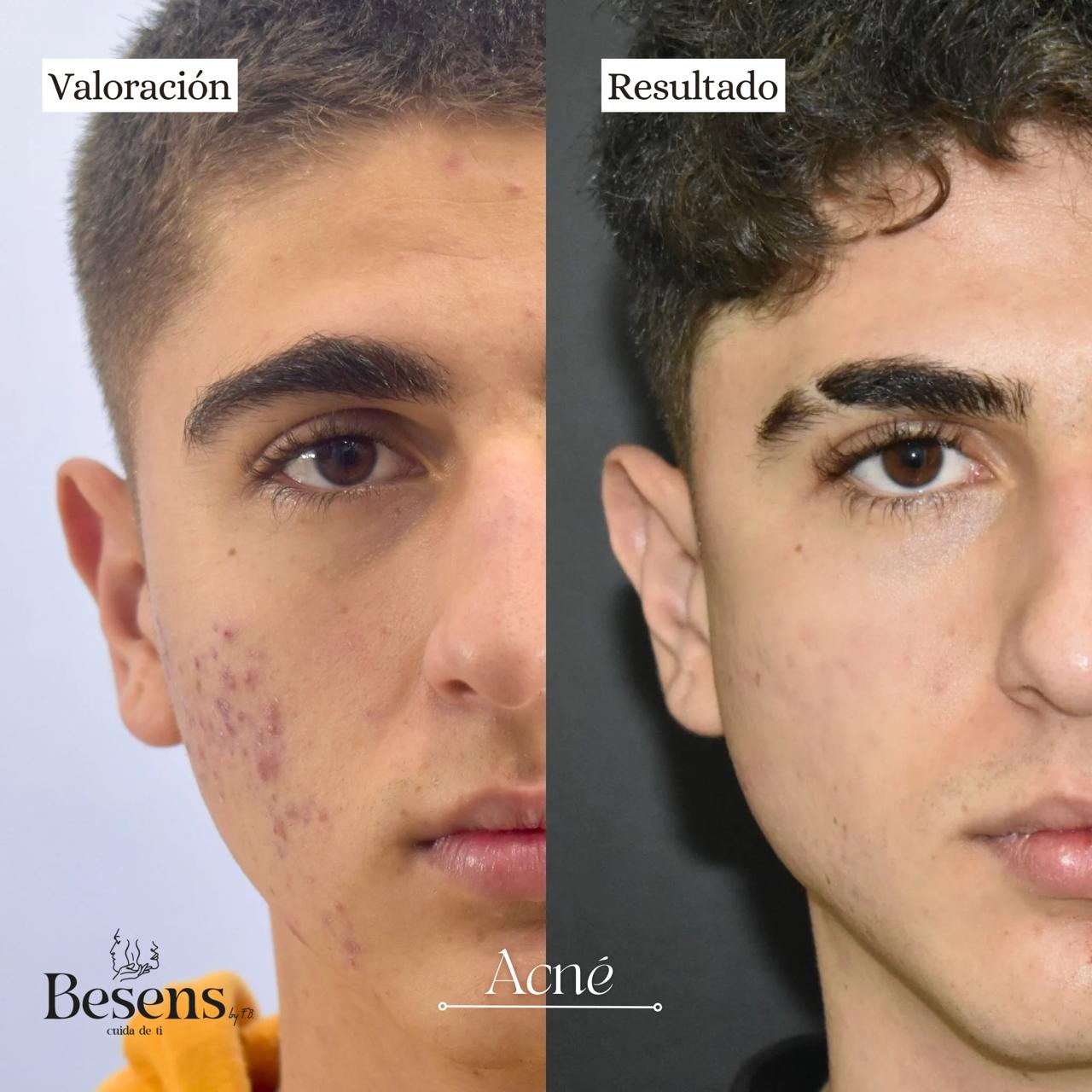 Paciente Acne 2