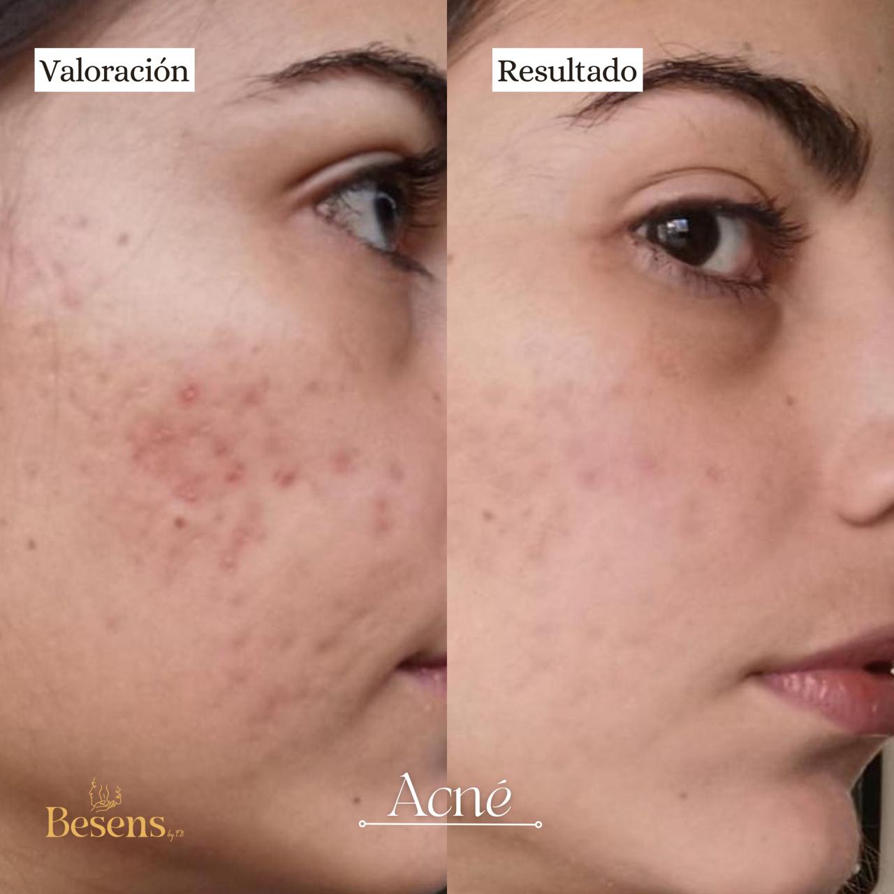 Paciente Acne 3