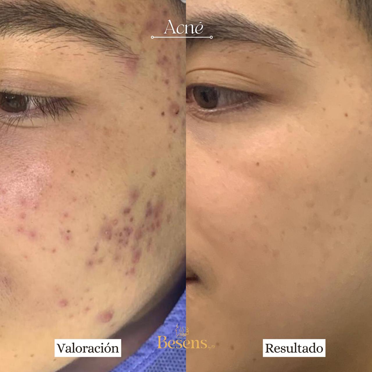 Paciente Acne 5