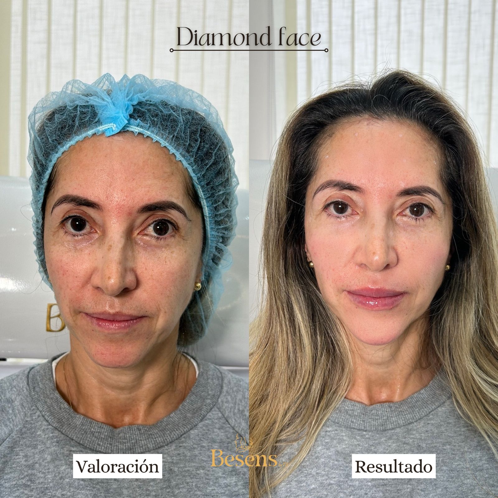 Paciente Full Face 1