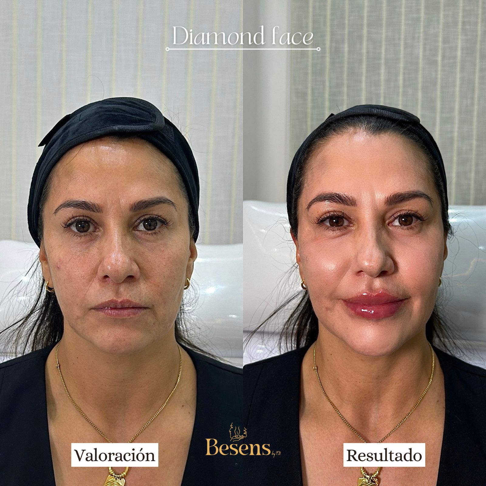 Paciente Full Face 2