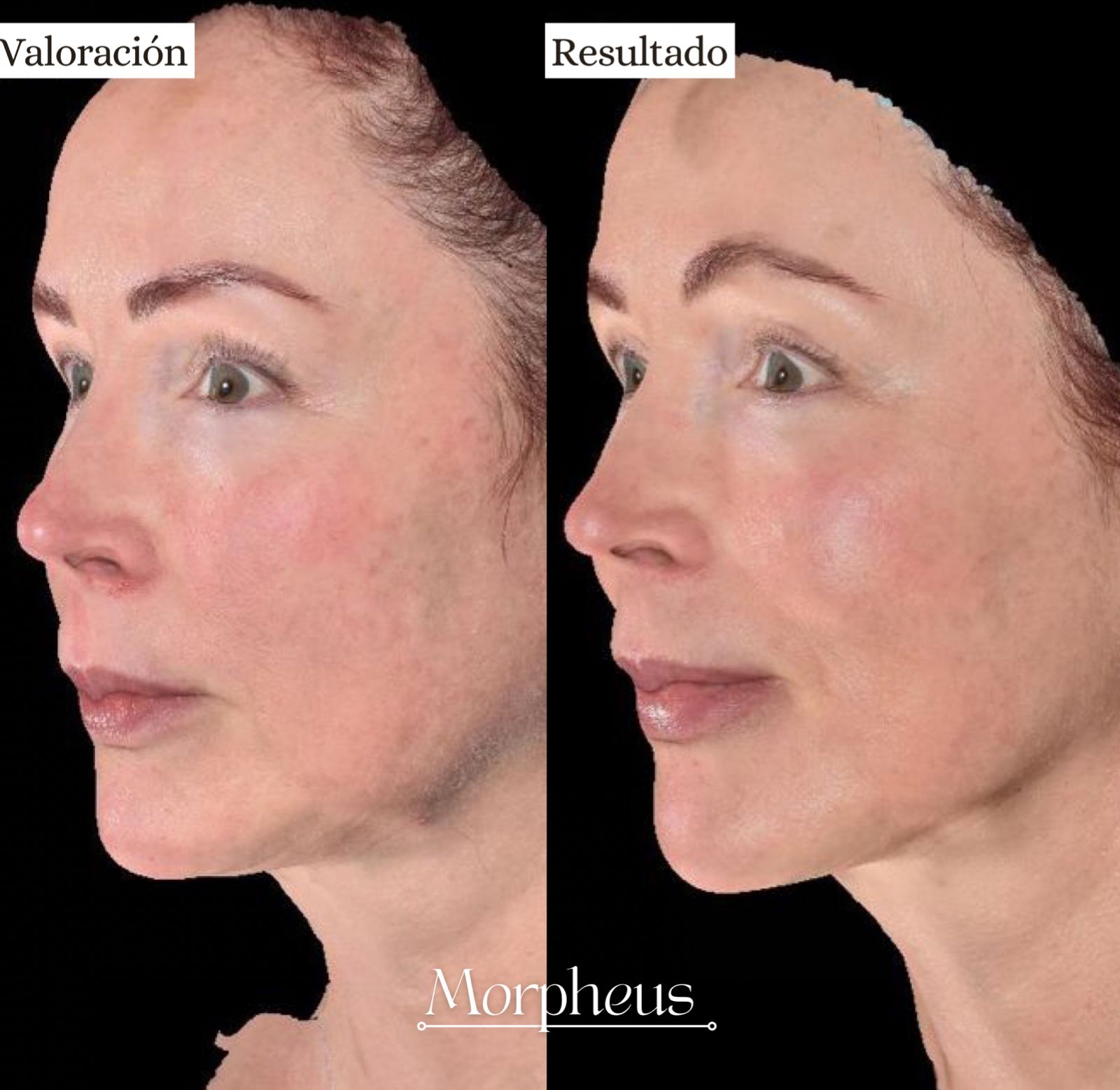 Paciente Morpheus 2