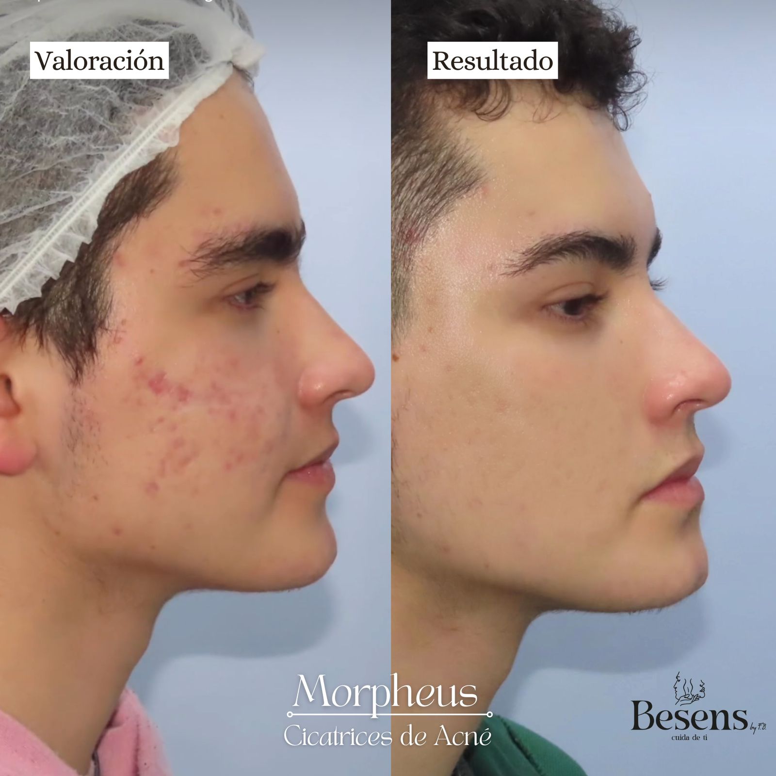 Paciente Morpheus Cicatrices Acne