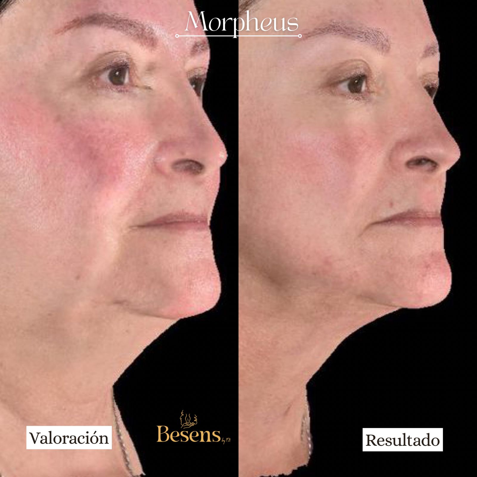 Paciente Morpheus papada 2