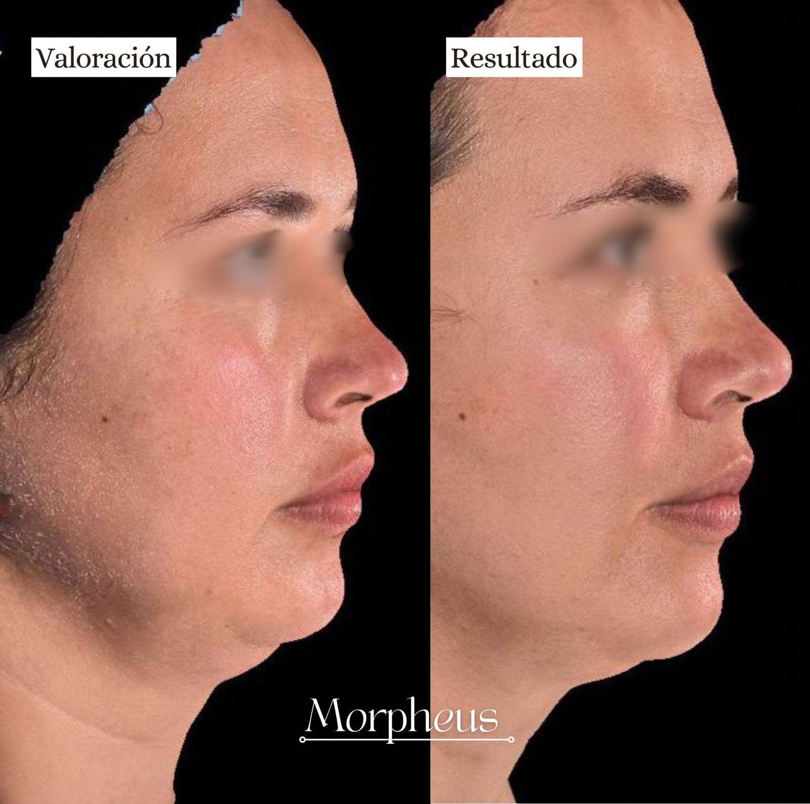 Paciente Morpheus papada