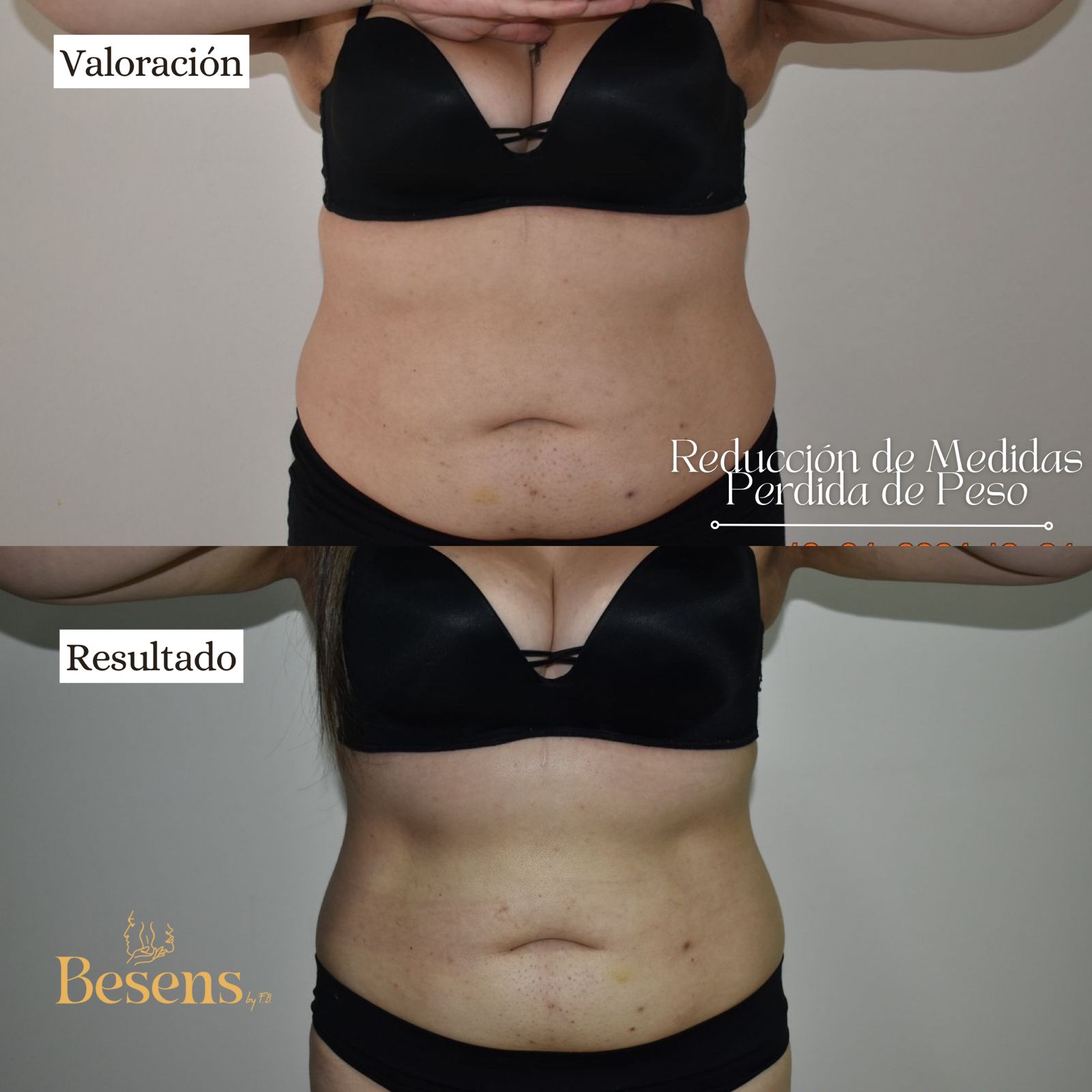 Paciente reduccion de peso